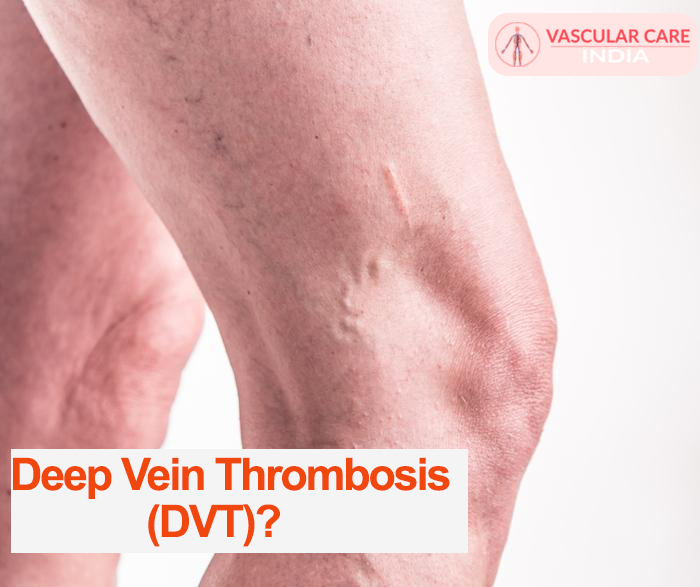 Deep Vein Thrombosis (DVT)?