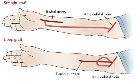 av fistula treatment doctor
