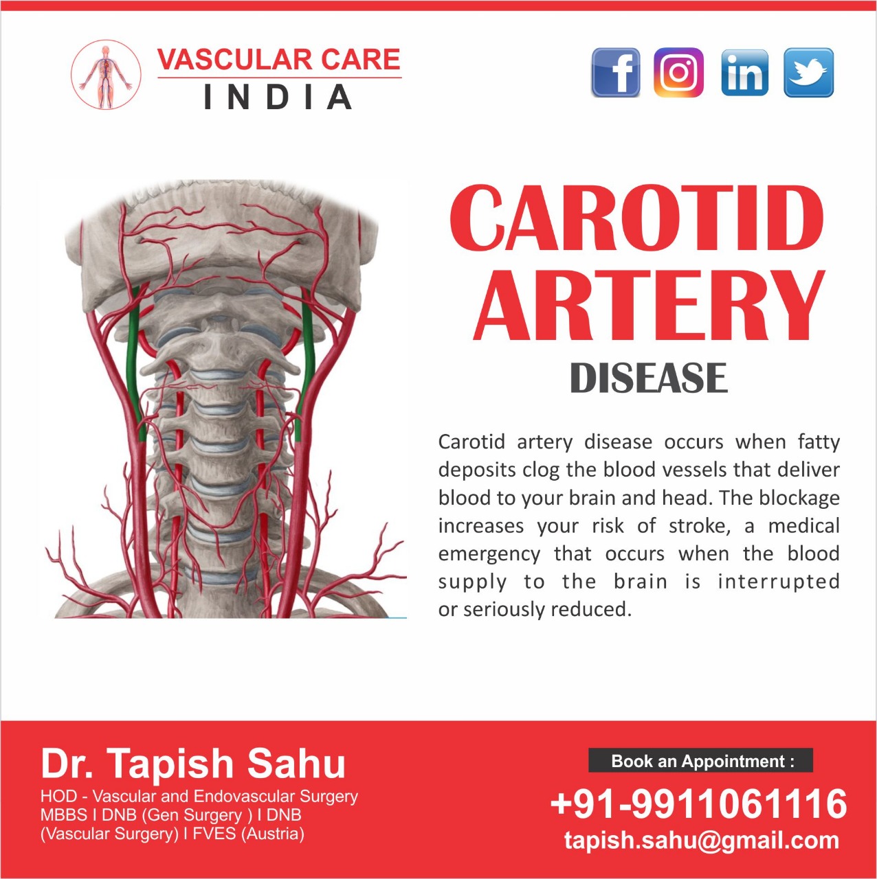Carotid Artery Disease