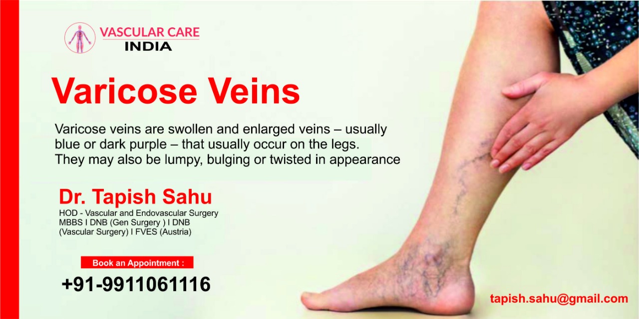 Varicose Veins