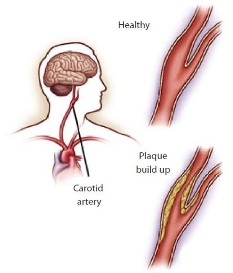 Carotid Artery Disease