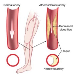 Peripheral Artery Disease