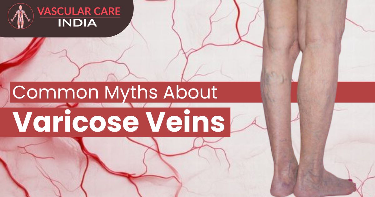 best varicose vein doctor in Delhi NCR